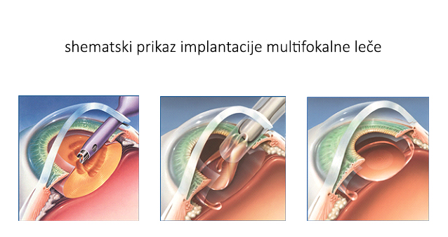 implantacija multifokalne leče.jpg