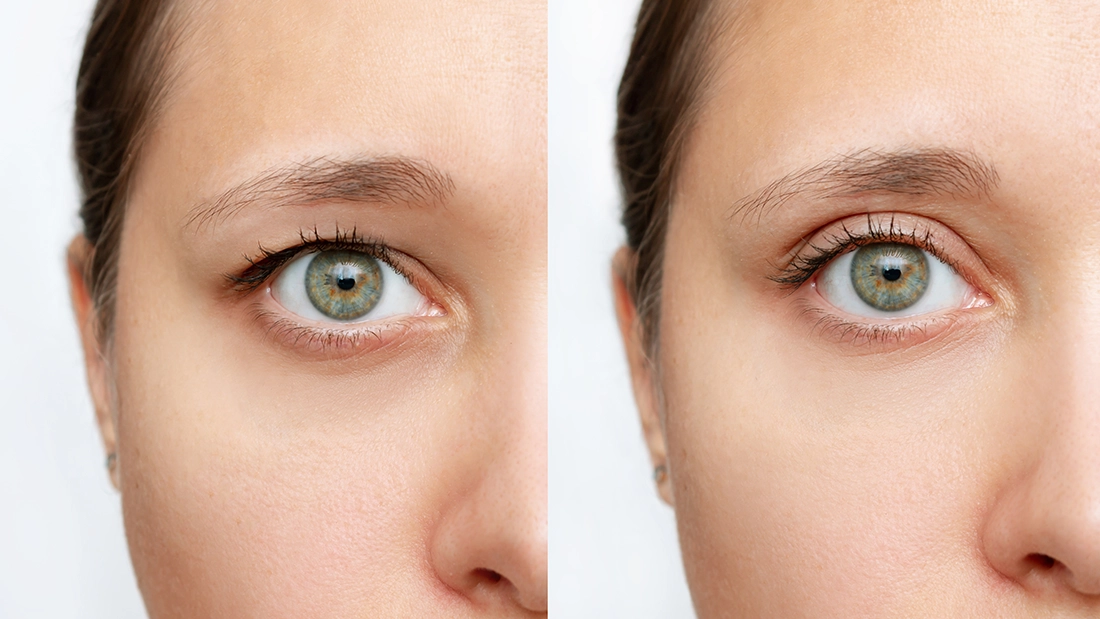 Blefaroplastika